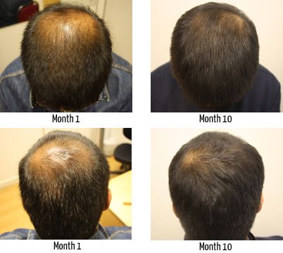 hair photo:fighting hair loss 